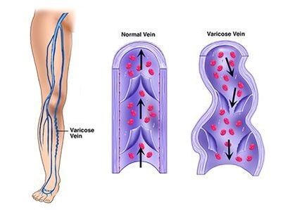 Neoveris previene lo sviluppo di patologie venose