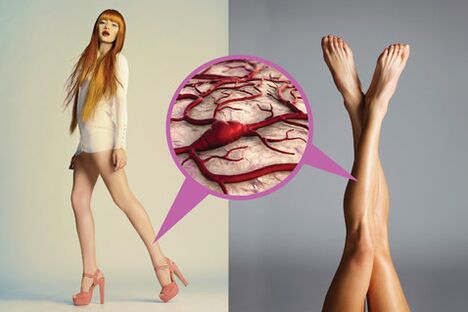 Vene varicose sulle gambe