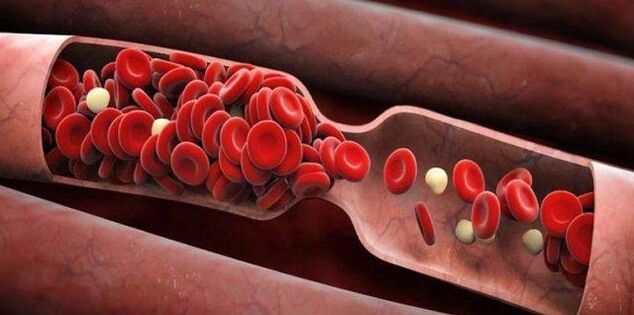 Prevenzione dei coaguli di sangue