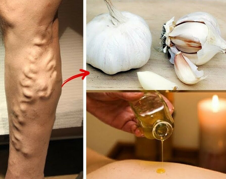 Medicinali per vene varicose
