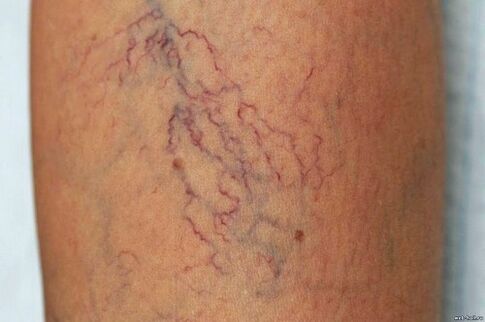 Perché le vene varicose sono pericolose
