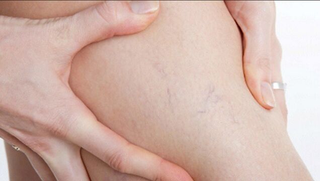 Le vene varicose sulle gambe sono un segno di vene varicose