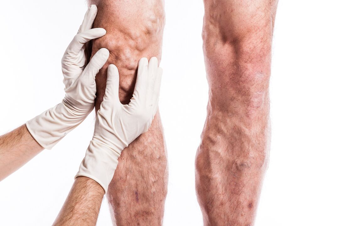 Il flebologo esamina le gambe di un paziente con vene varicose