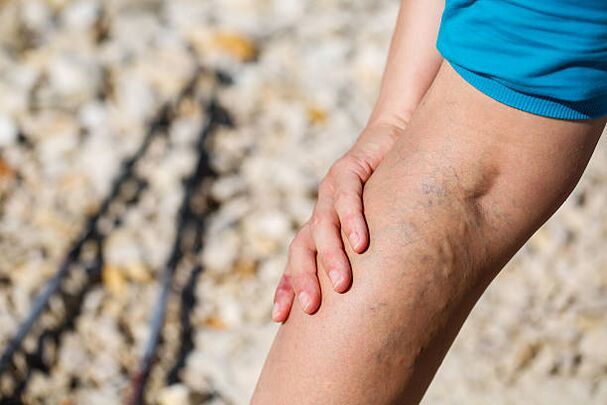 vene varicose delle gambe