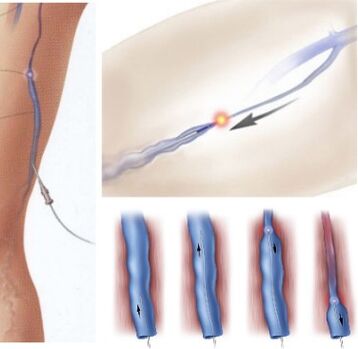 metodo di trattamento delle vene varicose - coagulazione laser endovenosa