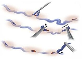 metodo di trattamento delle vene varicose - miniflebectomia
