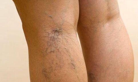 vene varicose sulle gambe