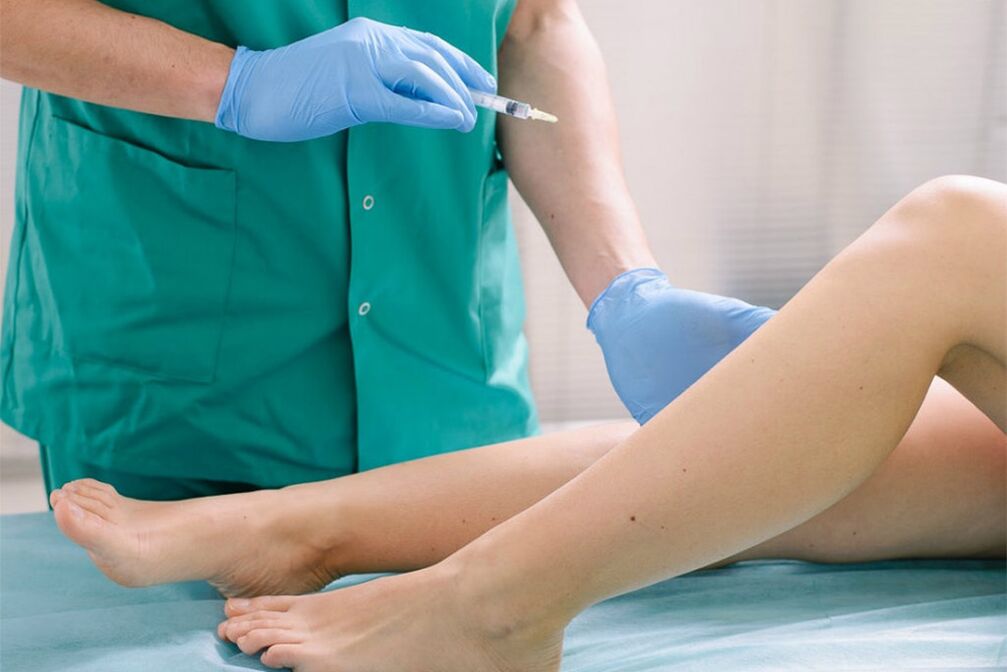 scleroterapia per la rimozione delle vene varicose
