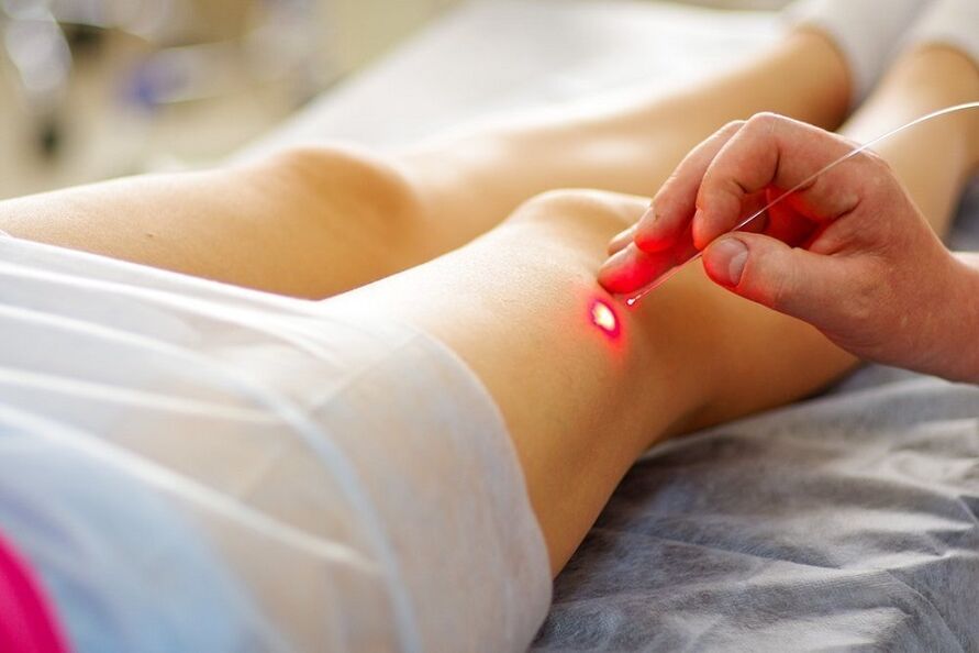 trattamento laser per vene varicose