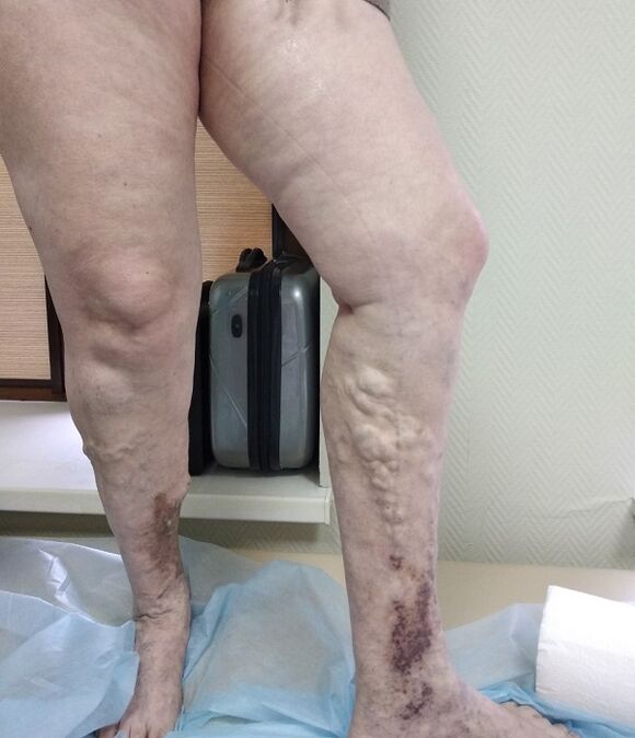 gambe con vene varicose