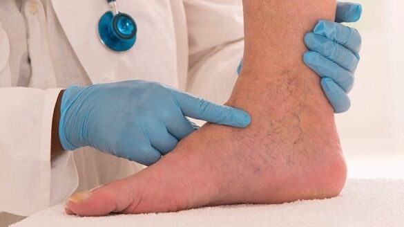 medico che esamina le gambe con vene varicose